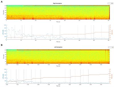 Case report: Bilateral double beta peak activity is influenced by stimulation, levodopa concentrations, and motor tasks, in a Parkinson’s disease patient on chronic deep brain stimulation